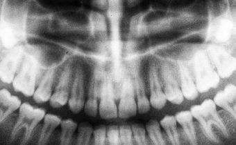 Everything you need to know about dental implants